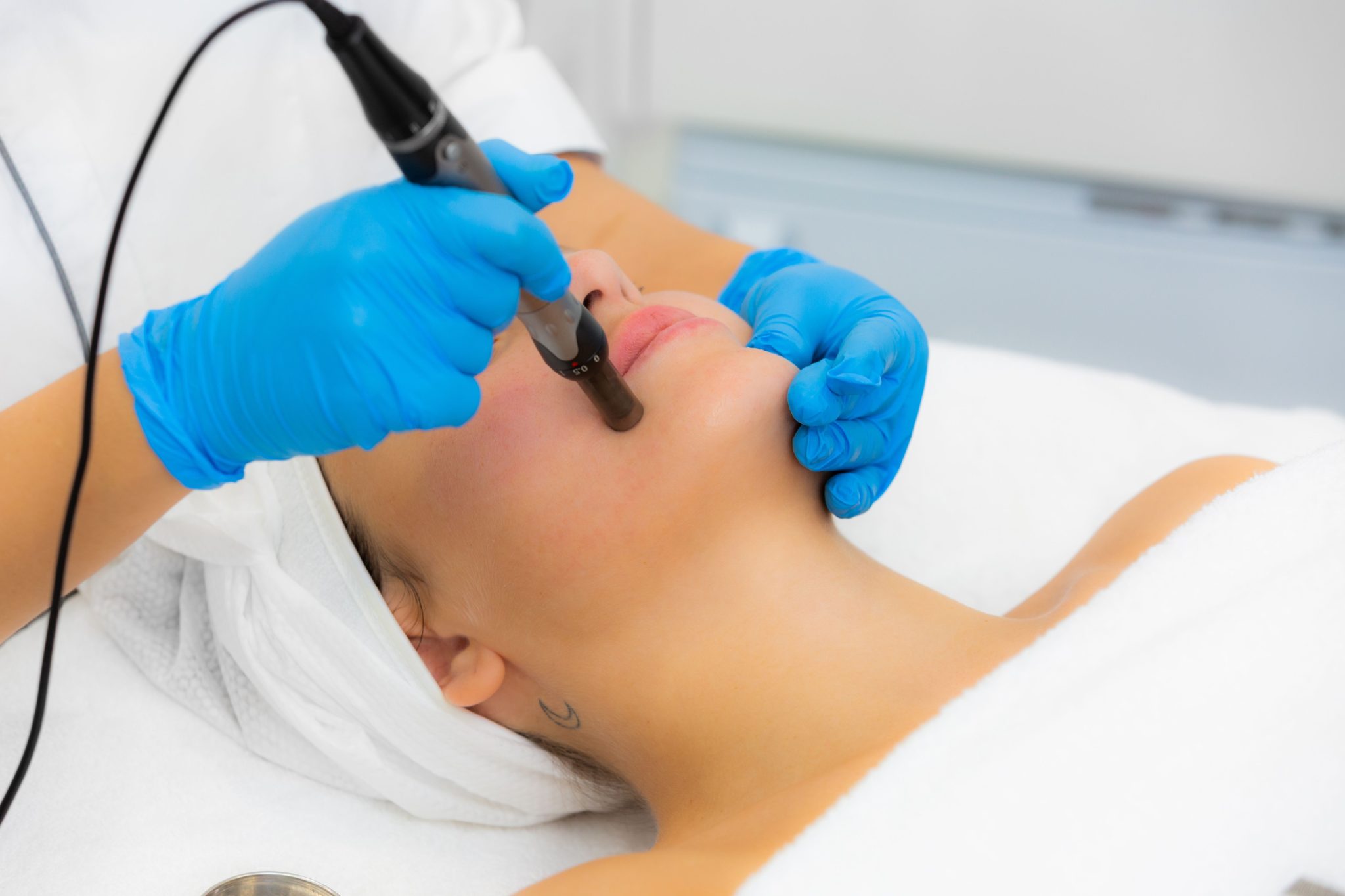 DIY Dermapen vs Professional Microneedling – The Facts Revealed